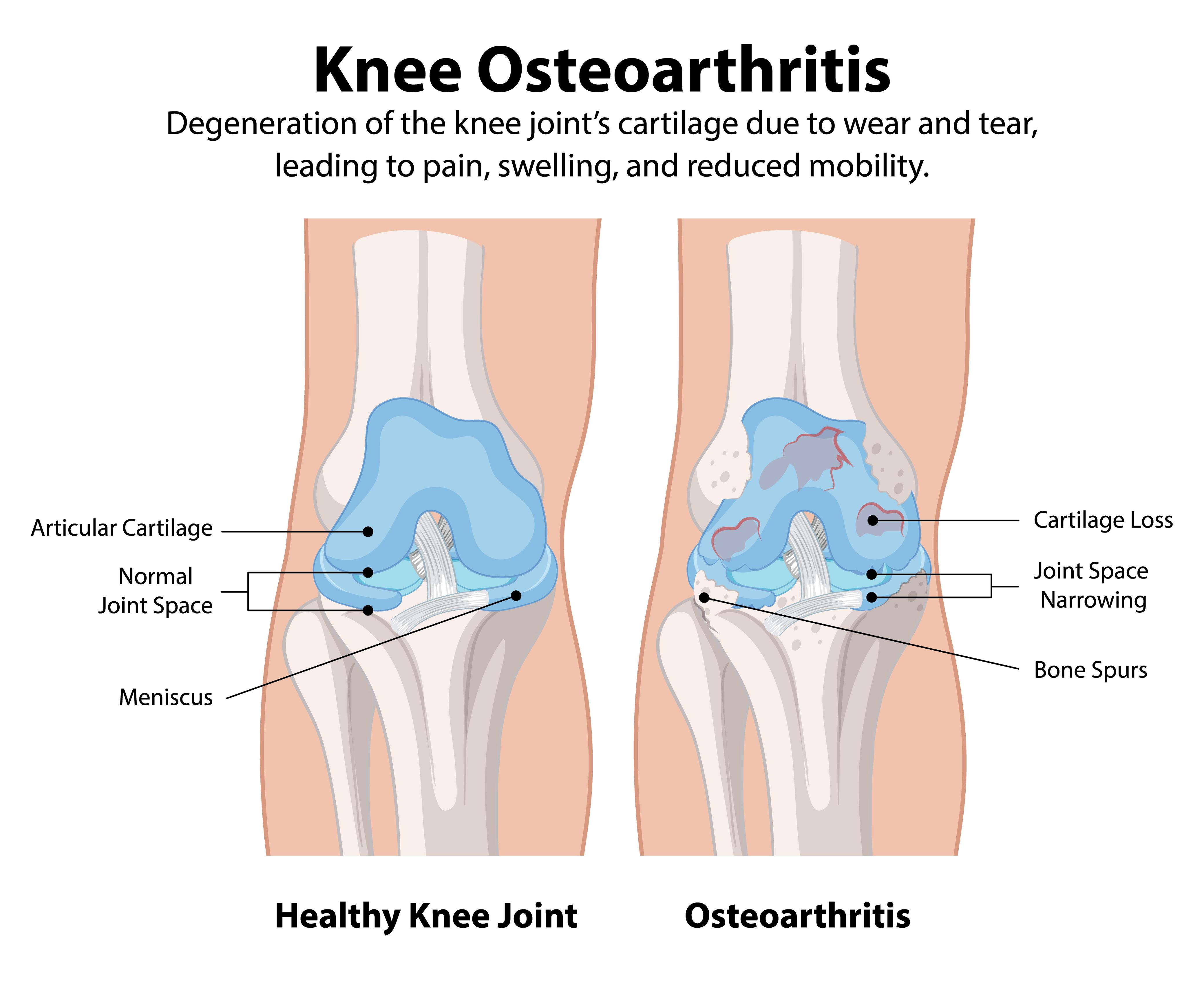 Exercises to prevent knee arthritis